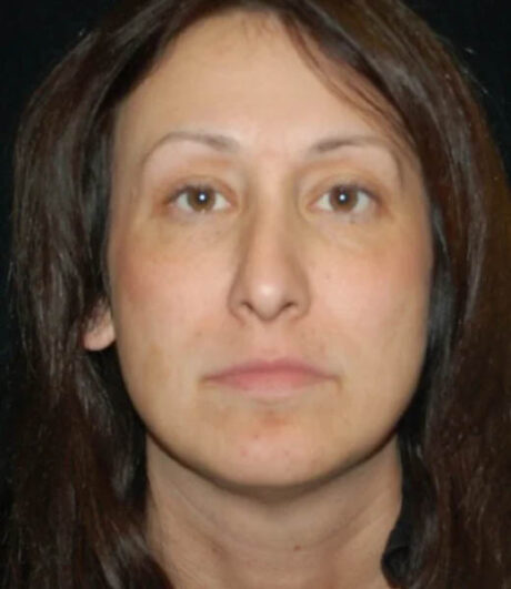 Revision Rhinoplasty case #13433