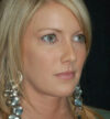 Rhinoplasty case #12789