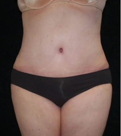 Tummy Tuck case #13547