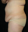 Tummy Tuck case #13547