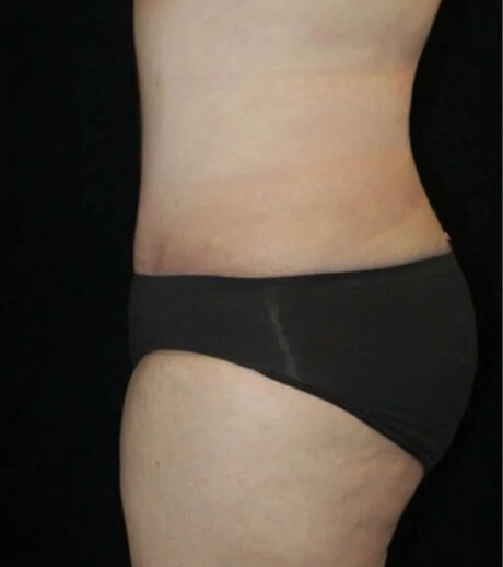 Tummy Tuck case #13547