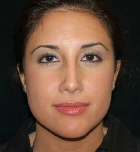Rhinoplasty case #12796