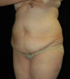 Tummy Tuck case #13547