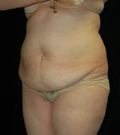 Tummy Tuck case #13547