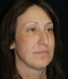 Revision Rhinoplasty case #13433