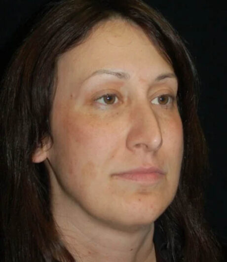 Revision Rhinoplasty case #13433