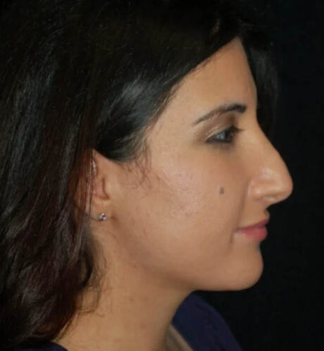 Rhinoplasty case #12796