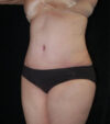 Tummy Tuck case #13547