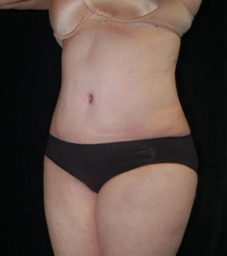 Tummy Tuck case #13547