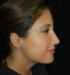 Rhinoplasty case #12796