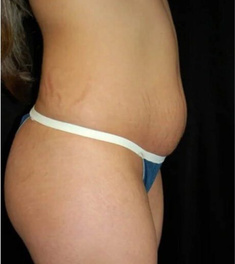 Tummy Tuck case #13554