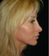 Revision Rhinoplasty case #13447