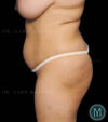 Tummy Tuck case #13563