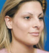 Rhinoplasty case #12808