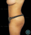 Tummy Tuck case #13563