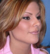Rhinoplasty case #12808