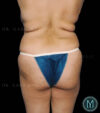 Tummy Tuck case #13563