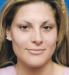Rhinoplasty case #12808