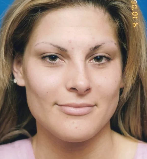 Rhinoplasty case #12808