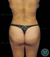 Tummy Tuck case #13563