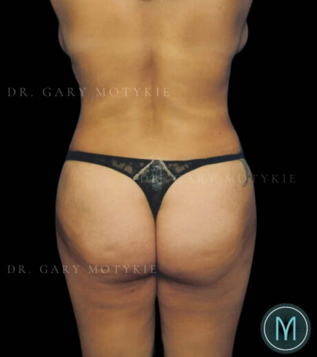 Tummy Tuck case #13563