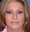 Rhinoplasty case #12808