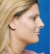 Rhinoplasty case #12808