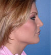 Rhinoplasty case #12808