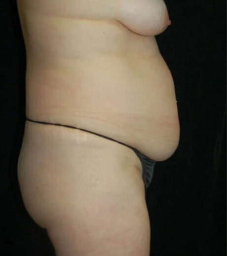 Tummy Tuck case #13568