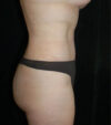 Tummy Tuck case #13568