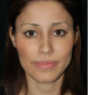 Rhinoplasty case #12815