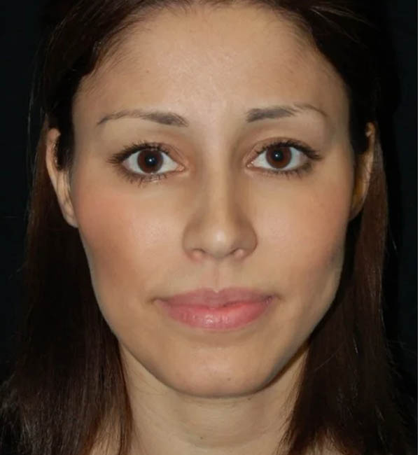 Rhinoplasty case #12815