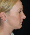 Revision Rhinoplasty case #13456