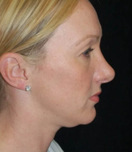 Revision Rhinoplasty case #13456