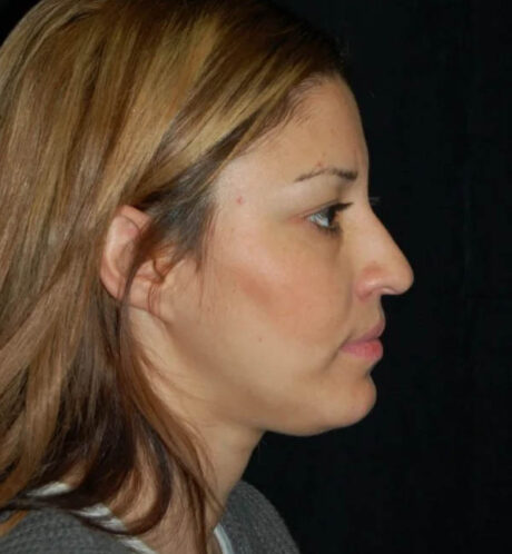 Rhinoplasty case #12815