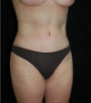 Tummy Tuck case #13568