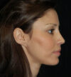 Rhinoplasty case #12815