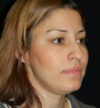 Rhinoplasty case #12815