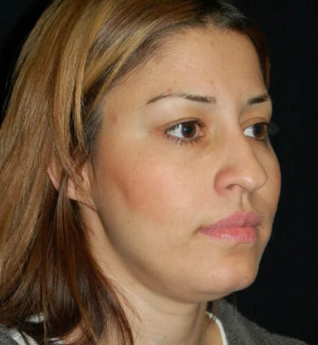 Rhinoplasty case #12815