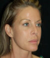 Revision Rhinoplasty case #13461