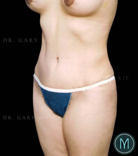 Tummy Tuck case #13575
