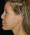 Revision Rhinoplasty case #13461