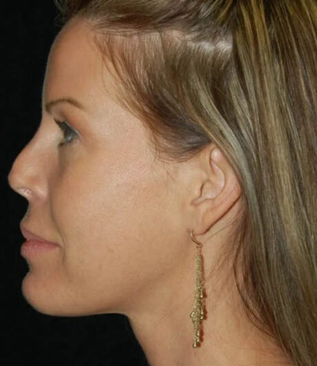 Revision Rhinoplasty case #13461