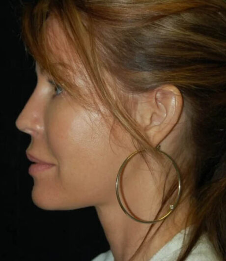 Revision Rhinoplasty case #13461