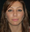 Rhinoplasty case #12822