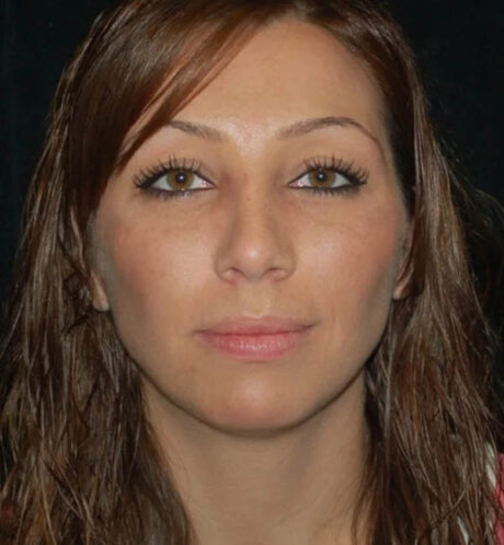 Rhinoplasty case #12822