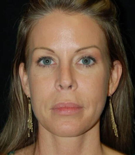 Revision Rhinoplasty case #13461