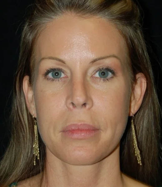 Revision Rhinoplasty case #13461