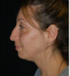 Rhinoplasty case #12822