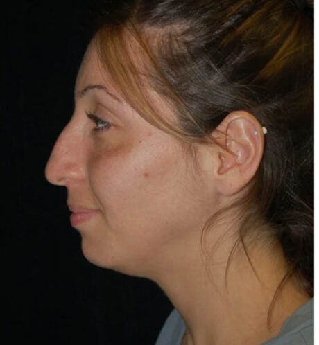 Rhinoplasty case #12822